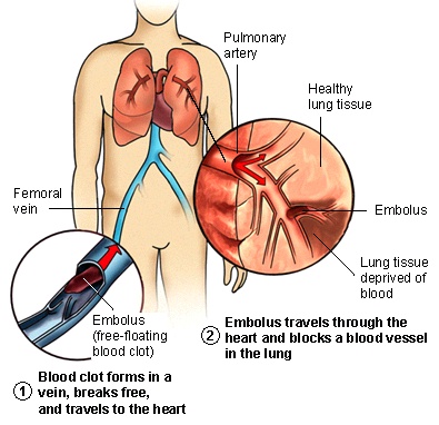 Pulmonary Embolism