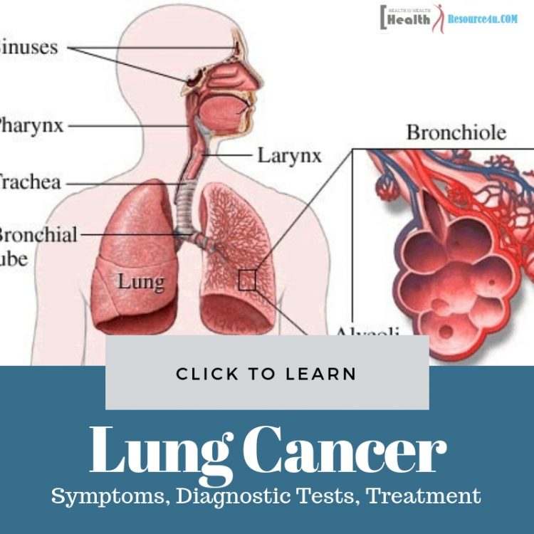 lung cancer diagnosis