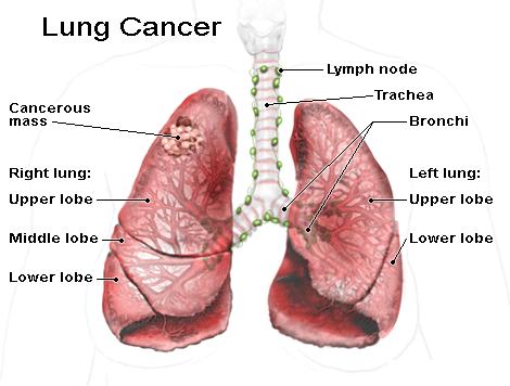 lung cancer