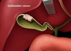 Gallbladder cancer