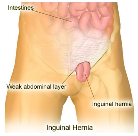 Inguinal Hernia pictures