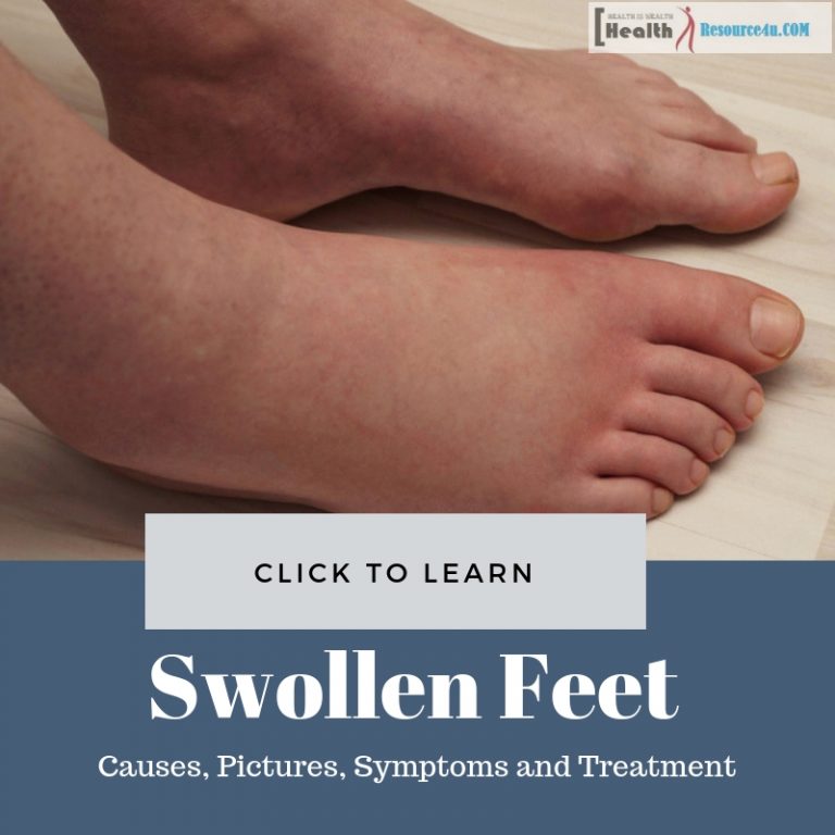 Swollen Feet Picture