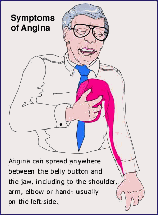 Symptoms of Angina