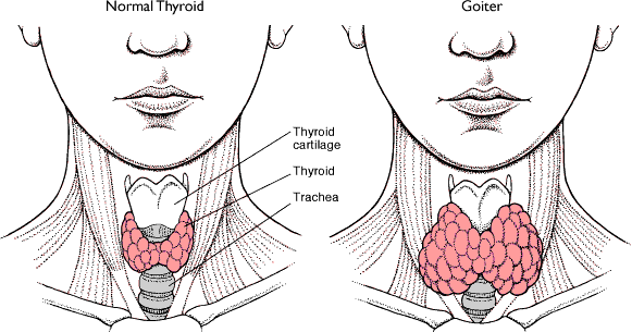 goiter pictures