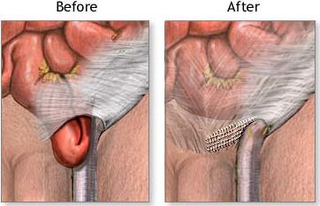 inguinal hernia repair