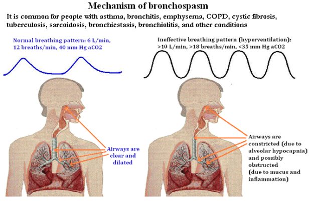 Bronchospasm Causes, Symptoms and Treatments