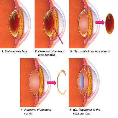 Cataract Surgery