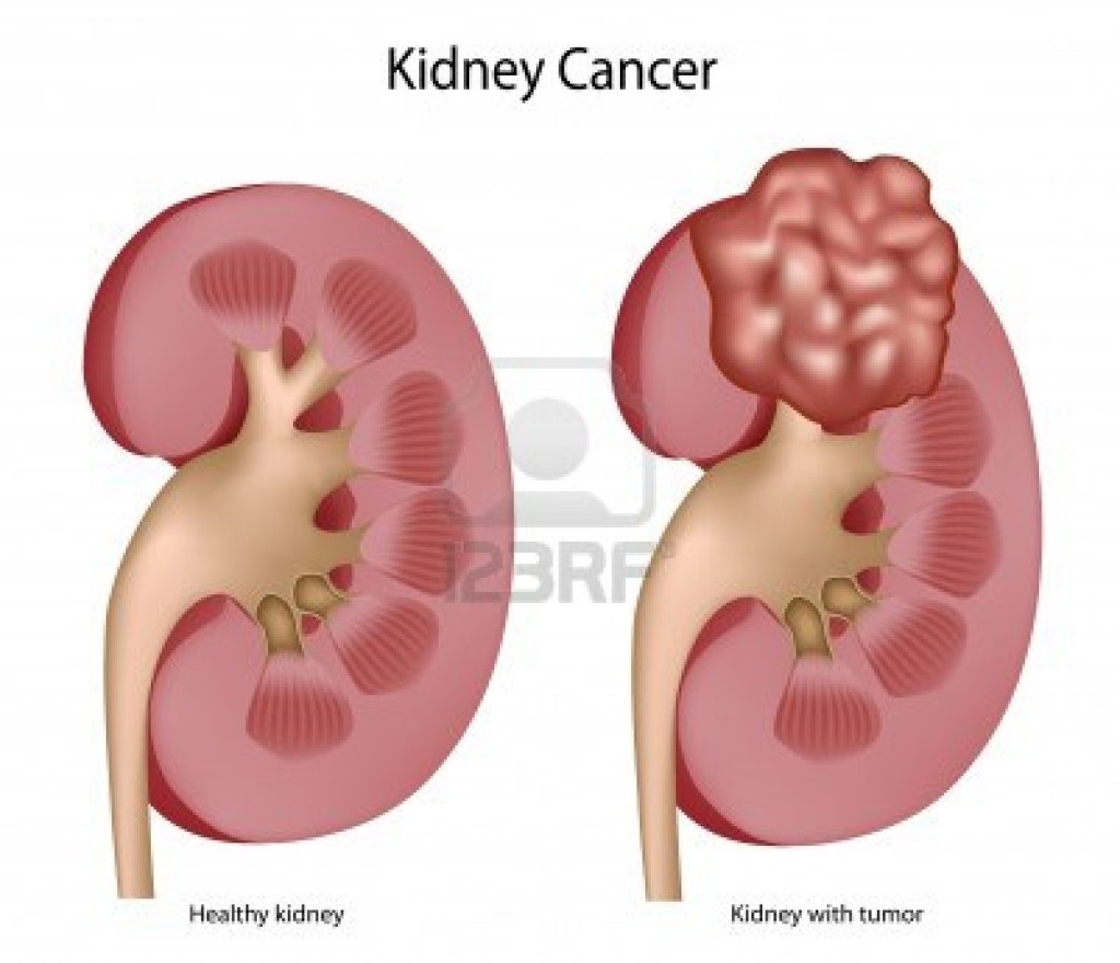 Kidney cancer