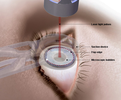 LASIK eye surgery