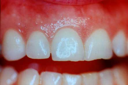 Maintain Healthy Gums and Teeth