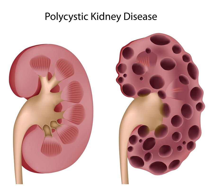 Polycystic Kidney Disease