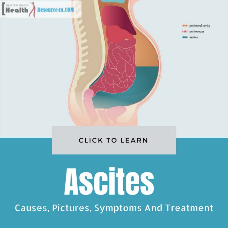 Ascites Causes and Treatment