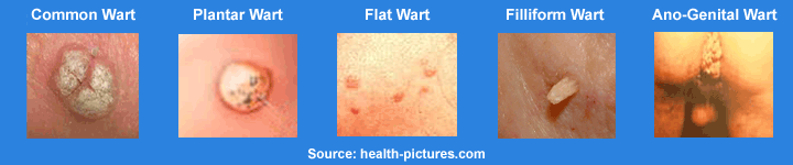 Different Types of Warts