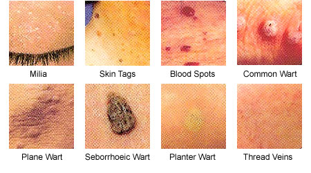 Different Types of Warts