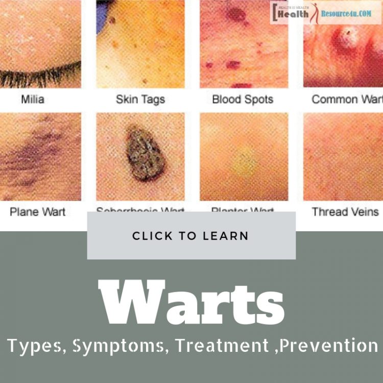 Warts Types, Symptoms, Treatment