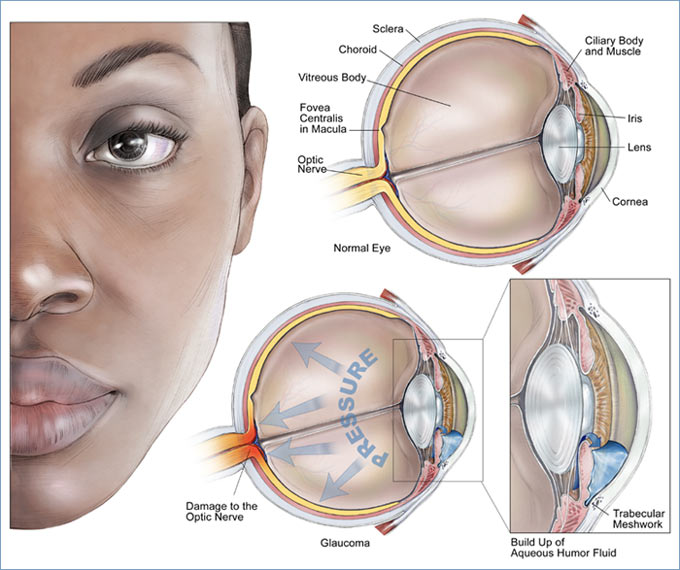 Glaucoma pictures