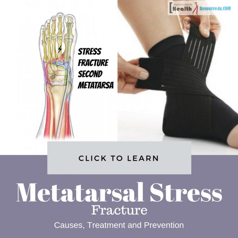 Metatarsal Stress Fracture