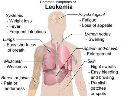 Leukemia symptoms