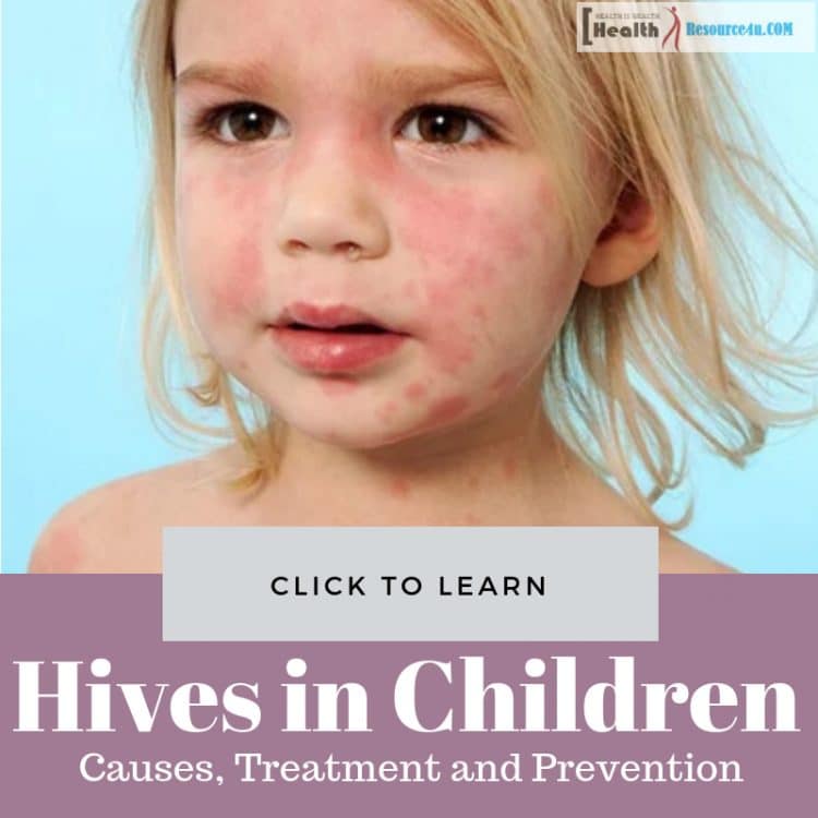 Hives in Children