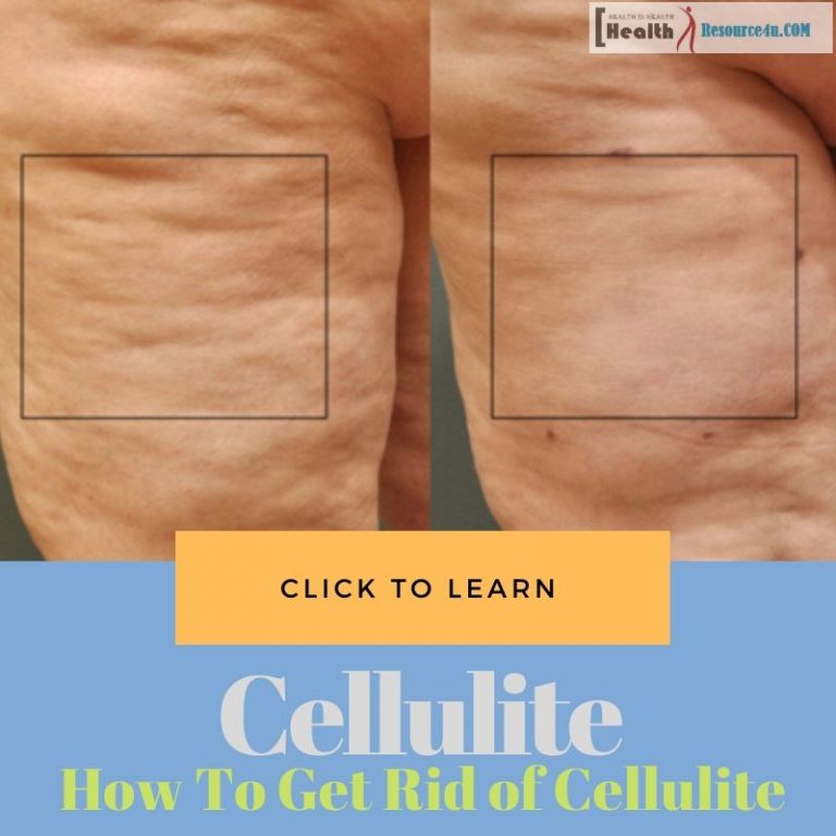 How To Get Rid of Cellulite