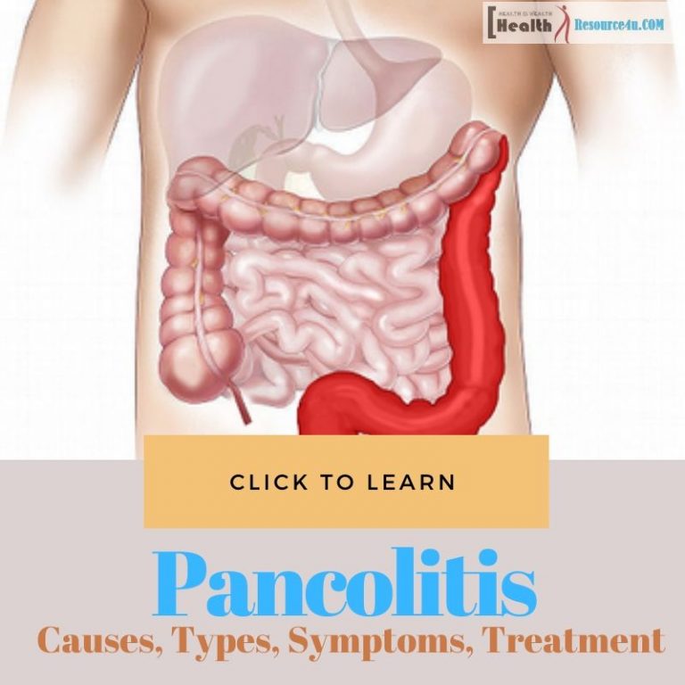 Pancolitis Picture