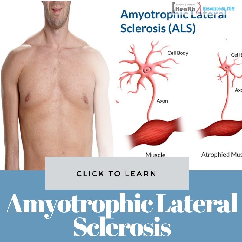 Amyotrophic Lateral Sclerosis