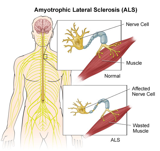 Amyotrophic Lateral Sclerosis