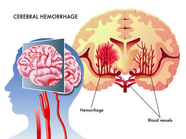 Cerebral Apoplexy