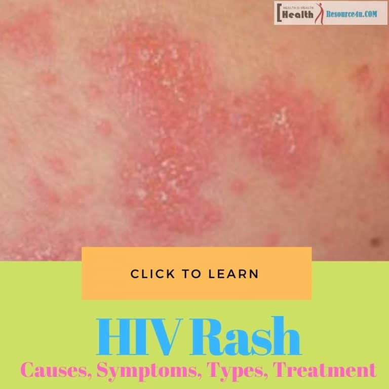 HIV Rash Picture