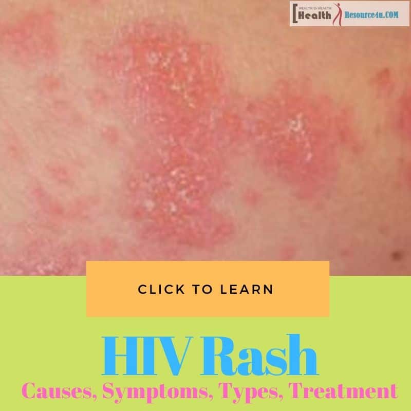 Hiv Rash Causes Picture Symptoms Types Home Treatment