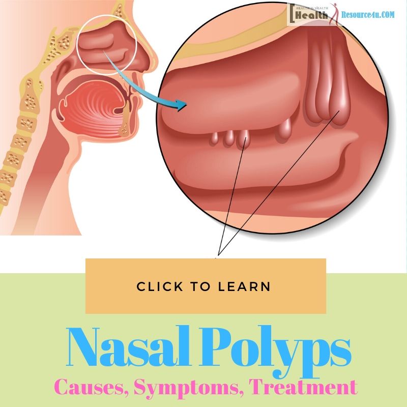 Nasal Polyps Picture