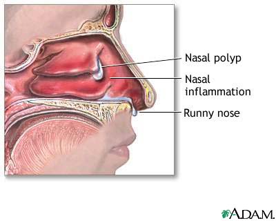 Nasal polyp steroid treatment