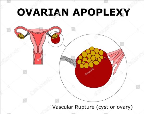 Ovarian Apoplexy