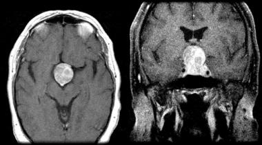 Pituitary Apoplexy