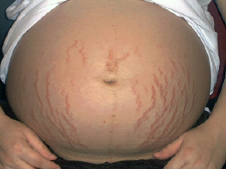 Pregnancy Stretch Marks