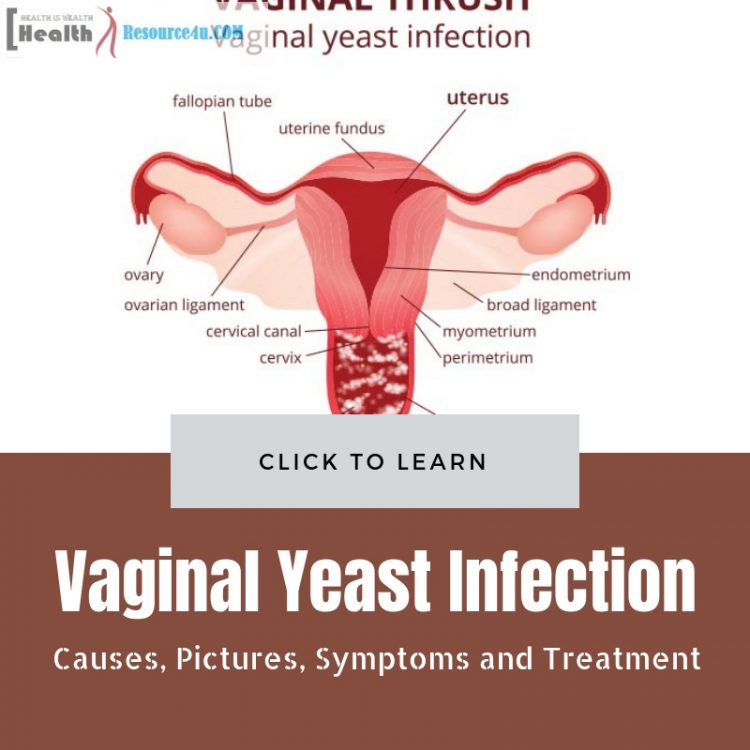 Vaginal Yeast Infection