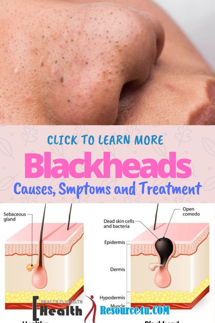 Blackheads Causes Treatment