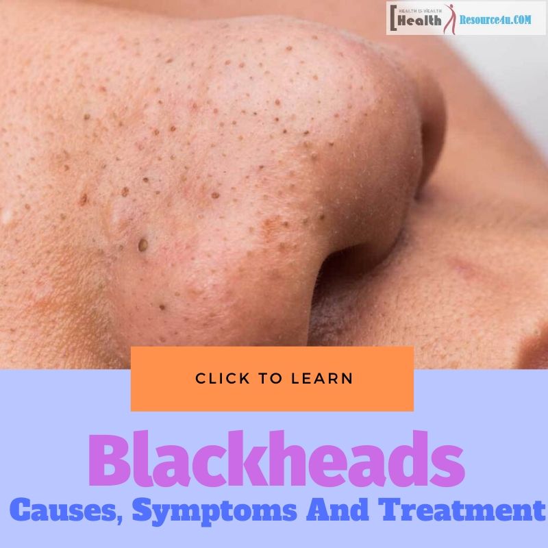 Blackheads