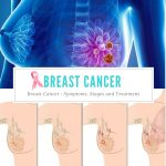 Breast Cancer Symptoms, Stages and Treatment
