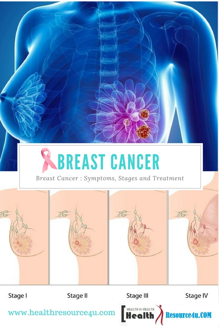 Breast Cancer Symptoms, Stages and Treatment