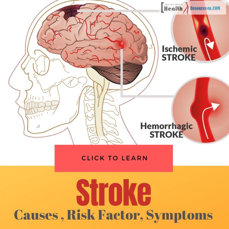 Causes Of Stroke