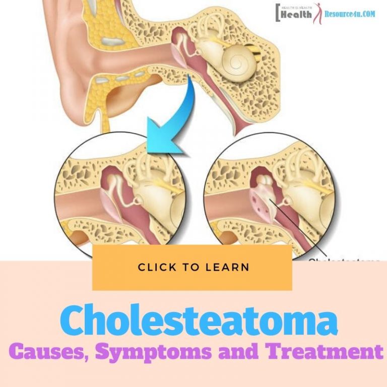 Cholesteatoma Causes Treatment