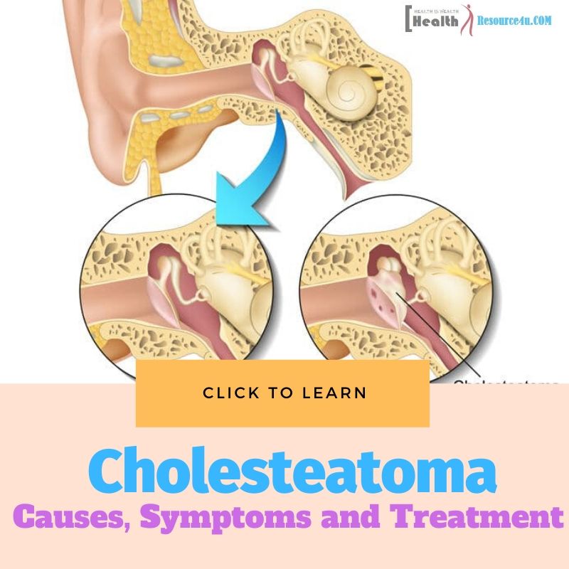 Cholesteatoma Causes Treatment