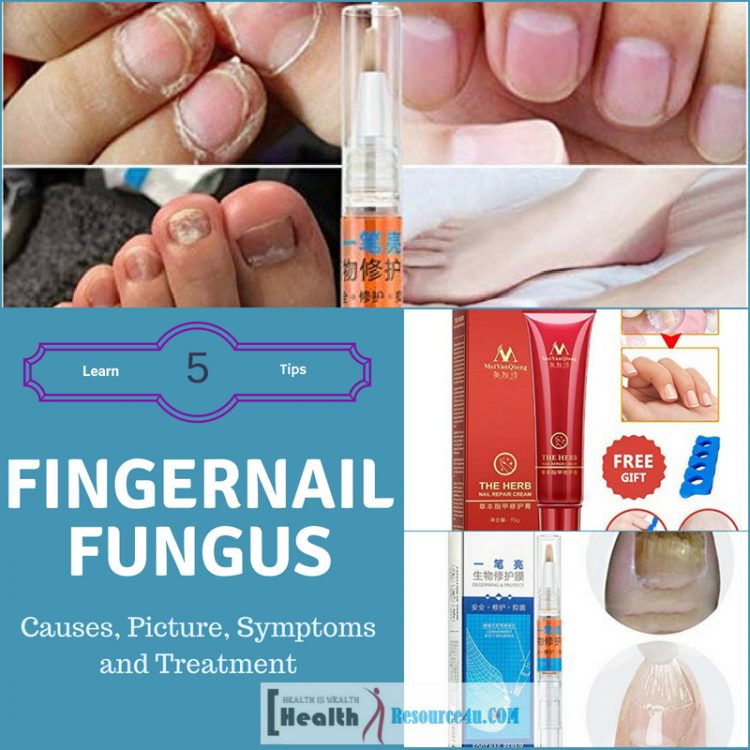 Fingernail Fungus Causes and Treatment