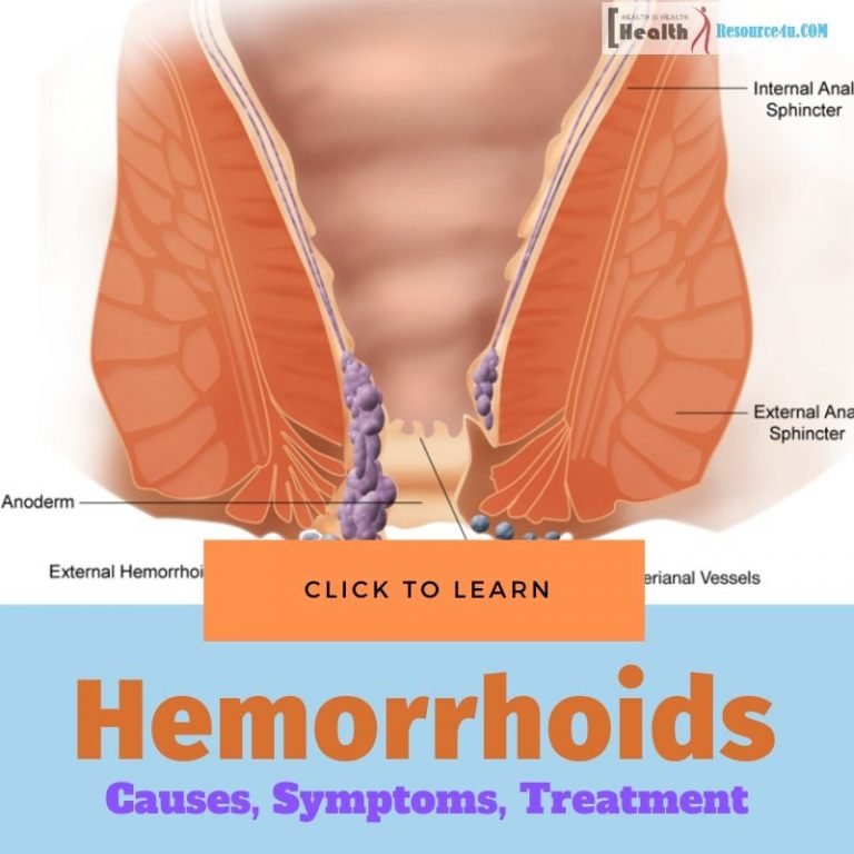 Hemorrhoids