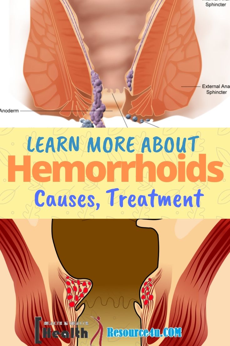 Hemorrhoids Causes Treatment