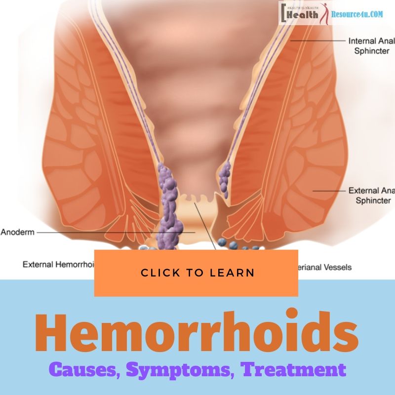 Hemorrhoids