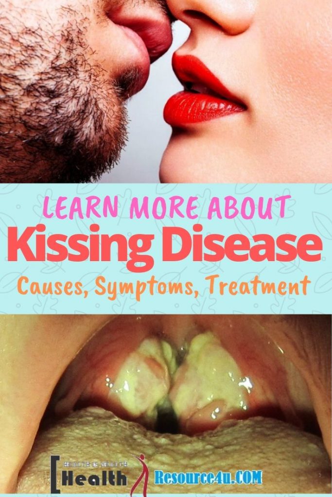 Kissing Disease Causes Treatment