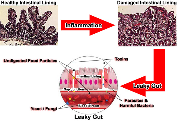 Leaky Gut Syndrome