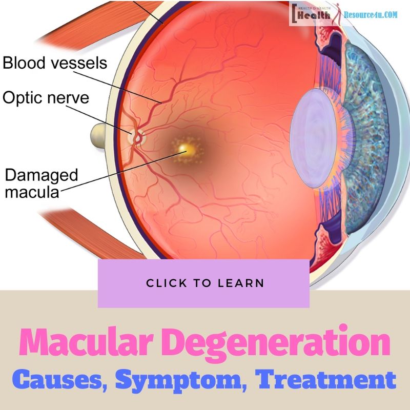 Macular Degeneration